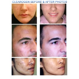 Clearogen 3 Step Acne Treatment Set 